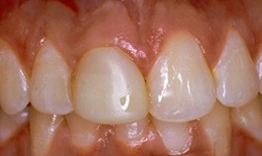 Close-up of upper front teeth showing dental work and natural tooth structure in clinical setting.