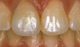 Close-up of front teeth showing white spot lesions and enamel discoloration on central incisors.