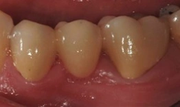 Close-up of three natural teeth showing yellow discoloration and worn surfaces in dental setting.
