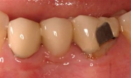 Close-up of lower teeth showing decay and discoloration on one tooth in mouth.