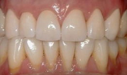 Close-up of upper and lower teeth showing white dental crowns and natural tooth alignment in mouth.