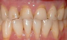 Close-up of upper and lower teeth showing natural tooth color and dental alignment after cosmetic treatment.