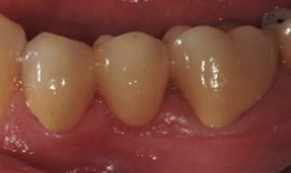 Close-up view of three natural teeth showing dental crown restoration work in clinical setting.