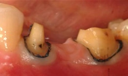 Close-up of dental implants showing metal posts in gum tissue during oral surgery procedure.