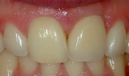 Close-up of upper front teeth showing dental work or tooth restoration in clinical dental setting.