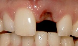 Dental implant procedure showing tooth extraction site with bone grafting material between natural teeth.