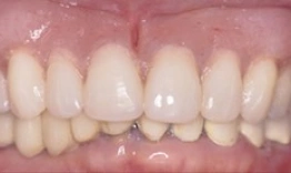 Close-up of upper front teeth showing dental work and tooth alignment in clinical setting.