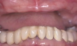 Close-up of dental prosthetics showing upper teeth implants or dentures in a mouth examination setting.