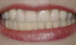 Close-up of a person's smile showing bright, evenly-aligned white teeth and pink lips.
