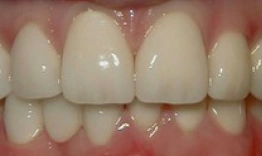 Close-up of healthy upper front teeth showing natural white dental crowns and restorations.