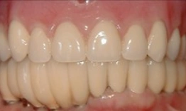 Close-up dental view showing upper and lower teeth with natural alignment and whitening results.