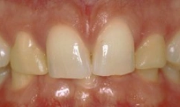 Close-up view of upper front teeth showing natural tooth color and dental work positioning.