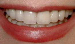 Close-up of healthy white teeth and smile showing cosmetic dental work results.