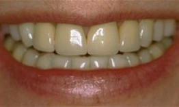 Close-up of a patient's smile displaying whitened upper and lower teeth with natural gum line.