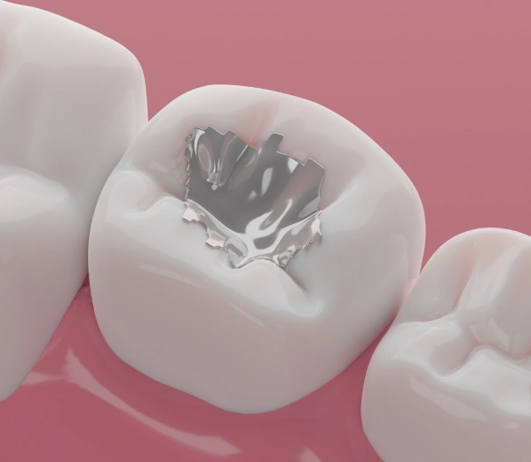 White tooth model showing internal decay damage against pink background, dental education illustration.