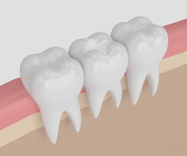 Three white teeth illustration showing dental anatomy with pink gums and beige jawbone cross-section.