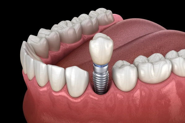 Dental implant illustration showing titanium post anchored in jawbone with crown restoration.