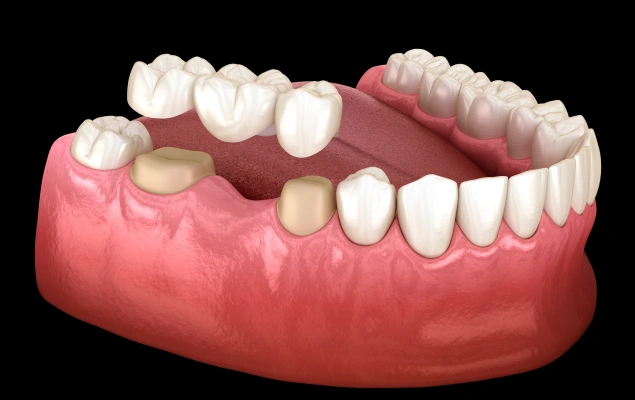 3D dental model showing lower jaw with natural teeth and gum structure against black background.