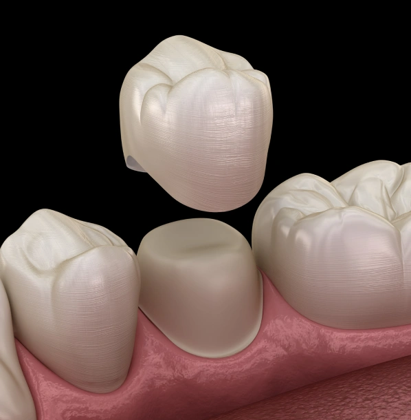 Dental crown restoration showing tooth-colored ceramic crowns on gum model for cosmetic dentistry.
