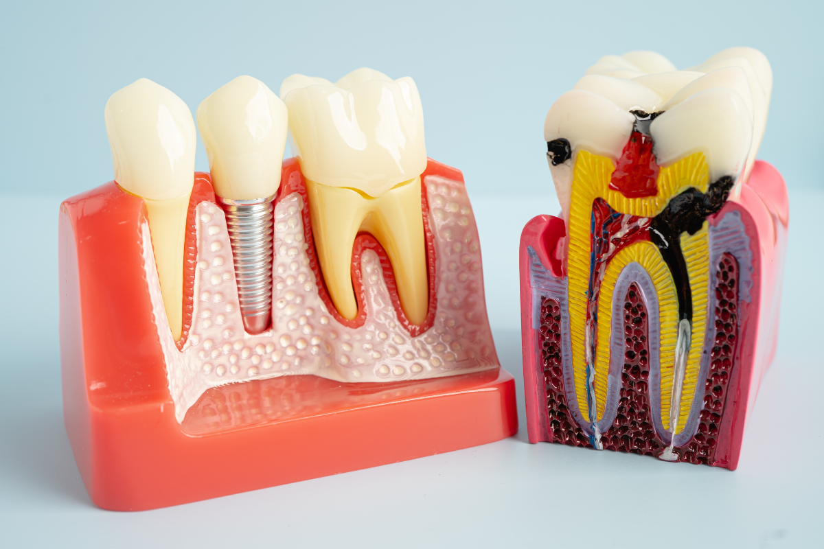 What Are the Signs You Might Need a Root Canal Treatment