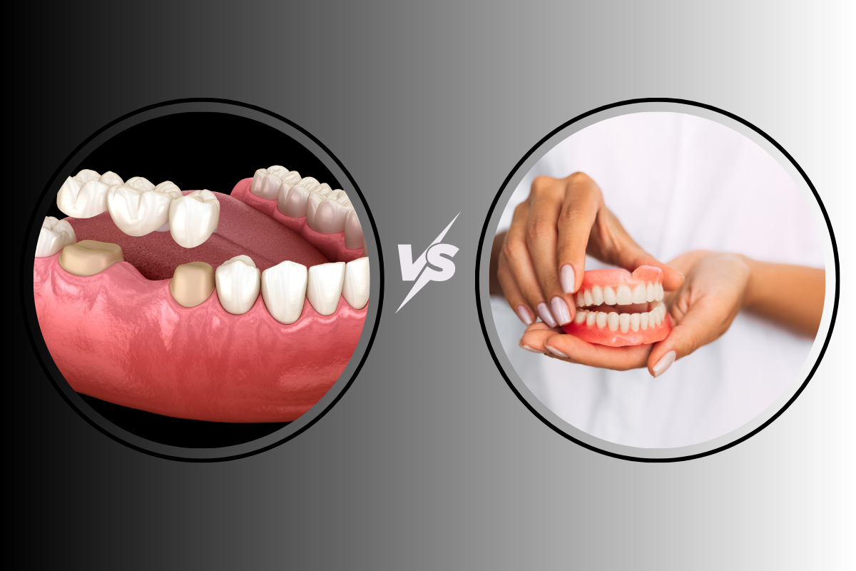 Dental Implant vs Bridge