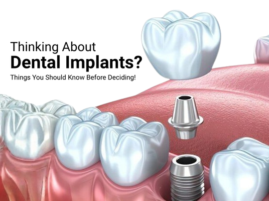 Thinking About Dental Implants Here’s What Tualatin Patients Should Know Before Deciding
