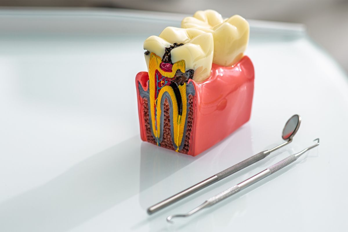 Dental model showing tooth cross-section with decay and dental instruments for examination.